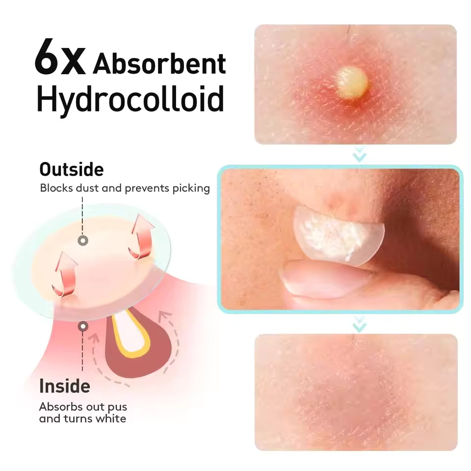 443pcs remendo de acne em gel  - Skincare Basic avaliação e preço