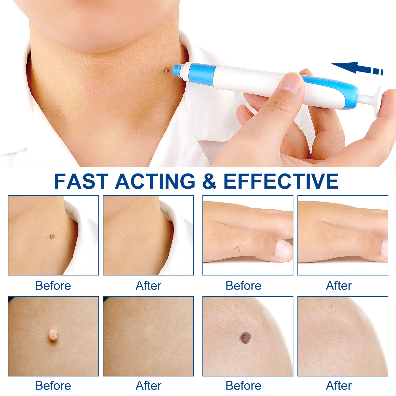 Kit de remoção automática de e - Skincare Ingredients Checker avaliação e preço